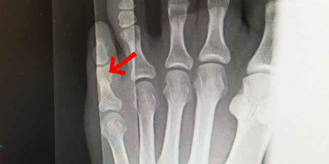 足 の 指 骨折 治療